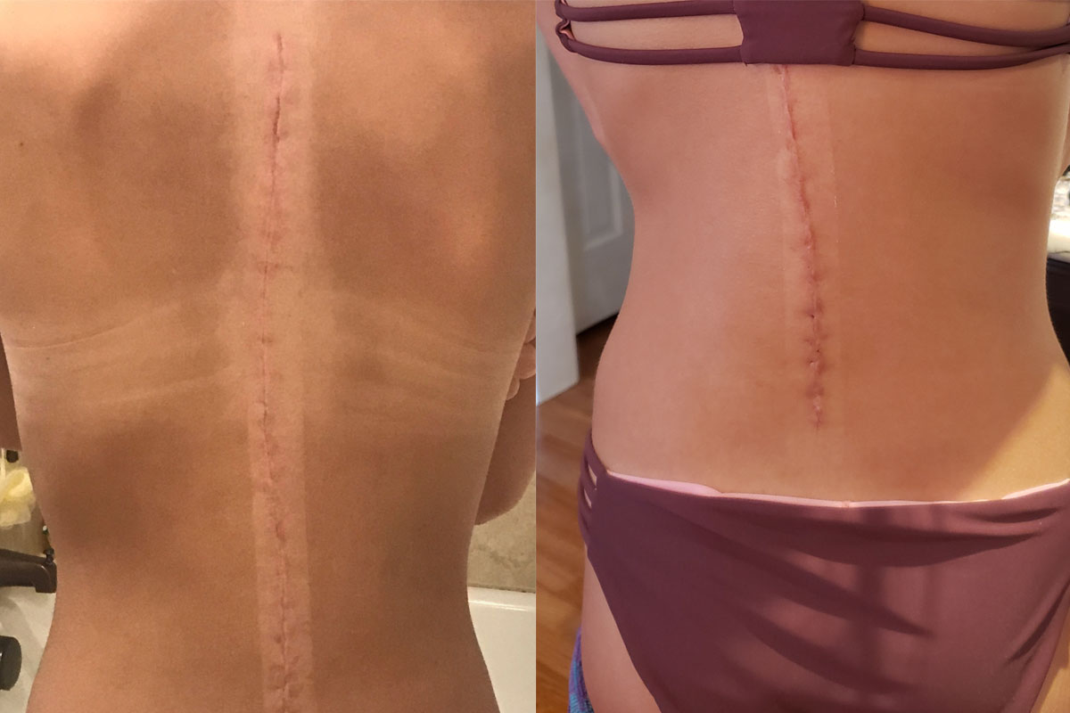 Can I Avoid Scar Tissue After Surgery?