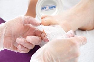 Effectively Dressing Diabetic Foot Ulcers - Topical Management Strategies
