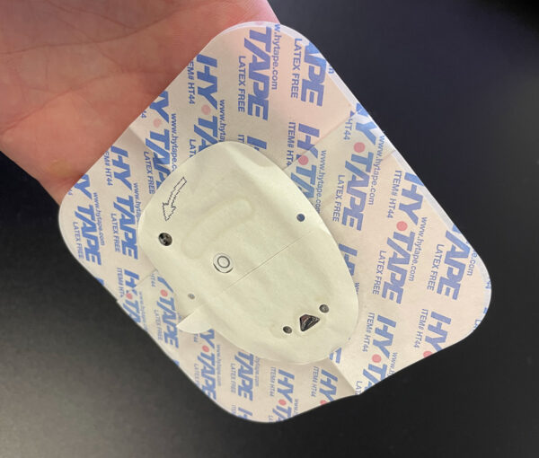 Tips for Dealing with Skin Irritation from Infusion Set & Continuous