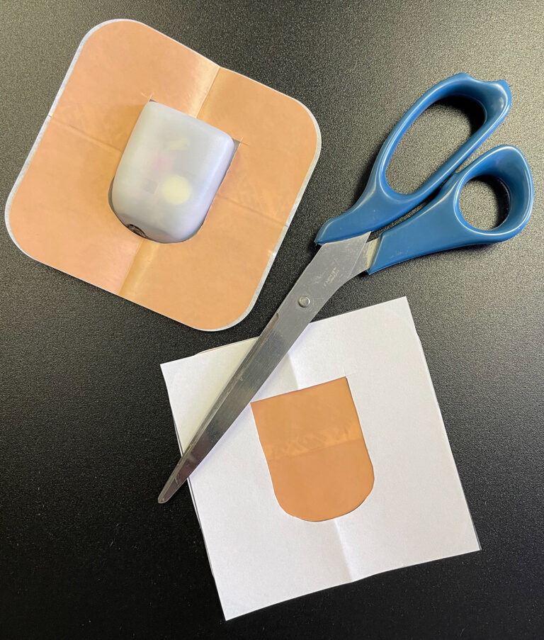 Tips for Dealing with Skin Irritation from Infusion Set & Continuous