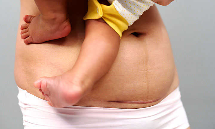 Caesarean Section, Wound Care & Scar Protection are Crucial