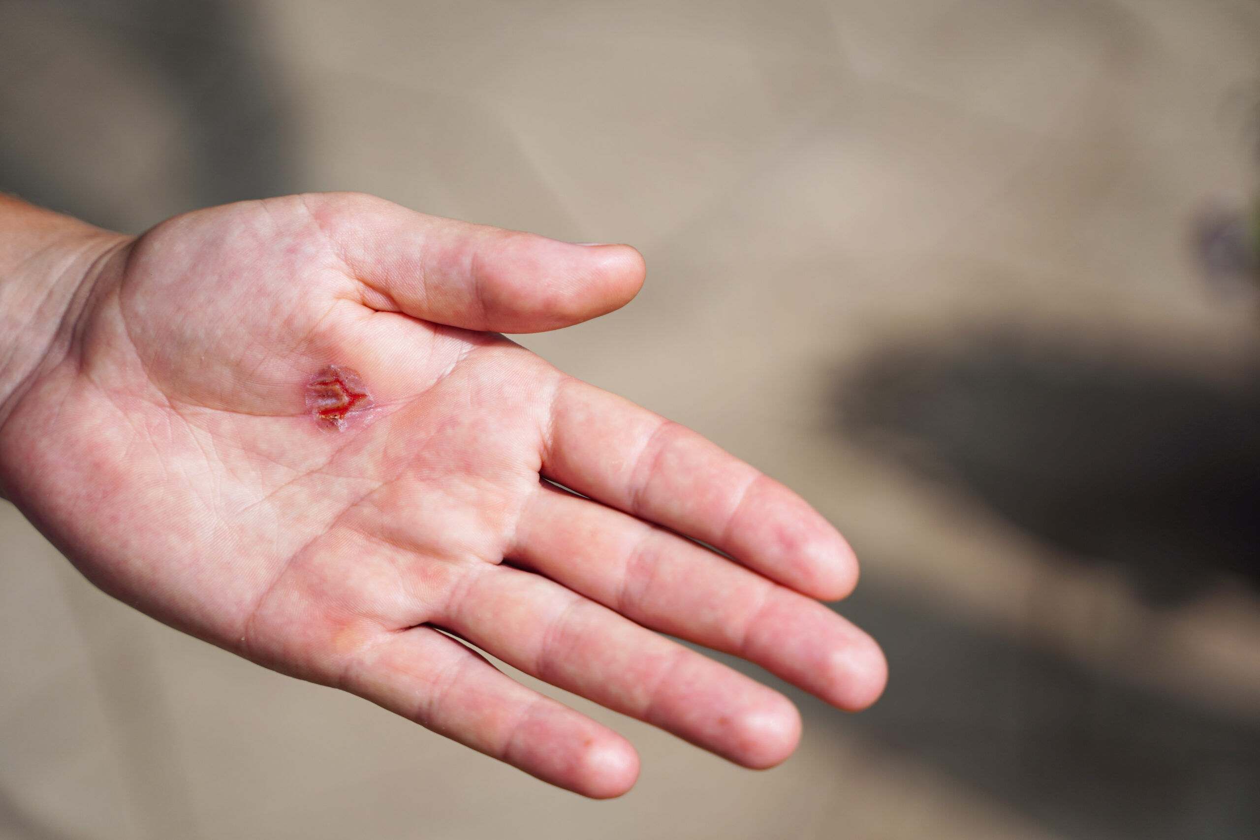 How to bandage skin injuries on the palm of your hand